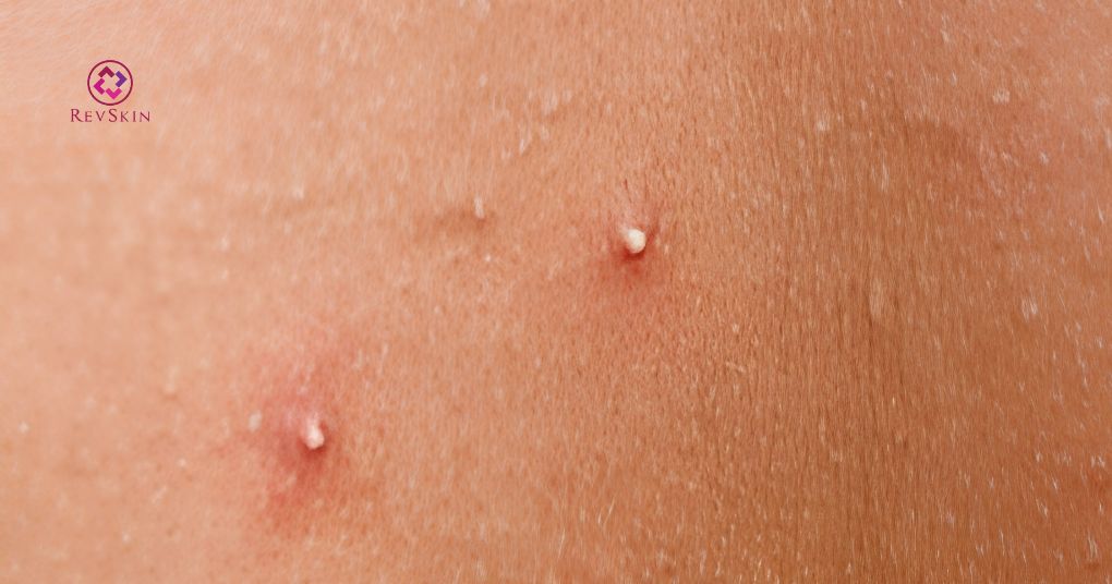Mụn đầu trắng: Nguyên nhân, vị trí và cách phòng ngừa mụn đầu trắng là gì