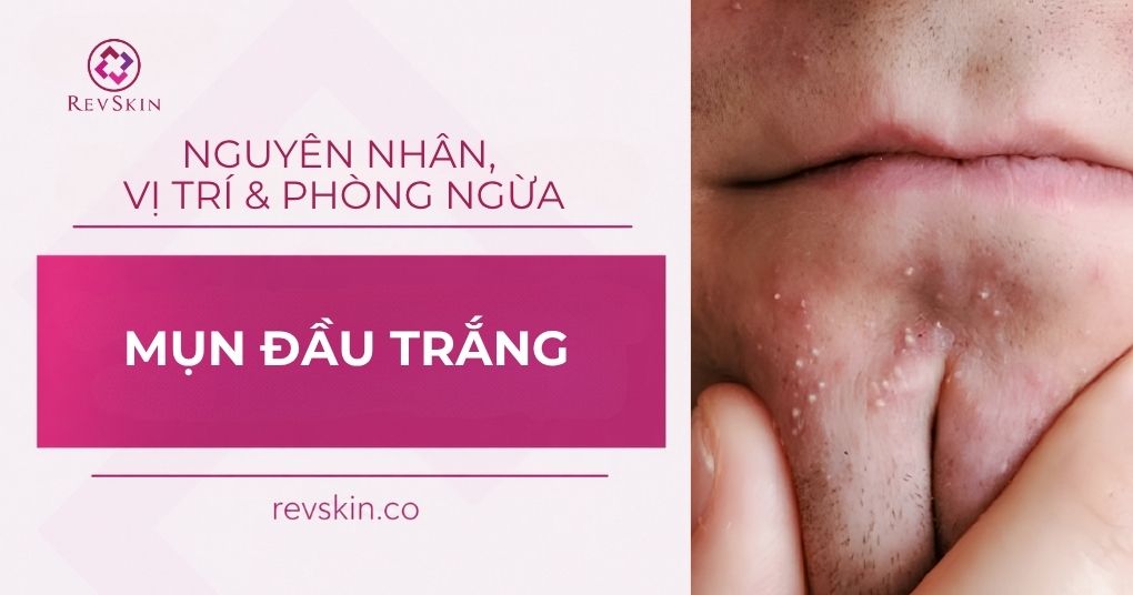 Mụn đầu trắng: Nguyên nhân, vị trí và cách phòng ngừa mụn đầu trắng