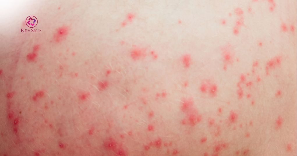 Peel mông là gì? Cơ chế, hoạt chất và quy trình chuẩn peel mông hỗ trợ điều trị mụn