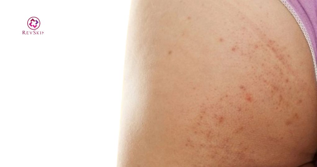 Peel mông là gì? Cơ chế, hoạt chất và quy trình chuẩn peel mông là gì