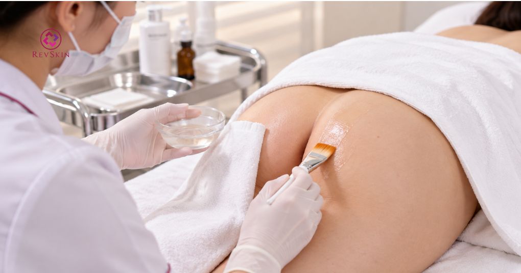 Peel mông là gì? Cơ chế, hoạt chất và quy trình chuẩn peel nông vùng mông cho thâm nông và dày sừng