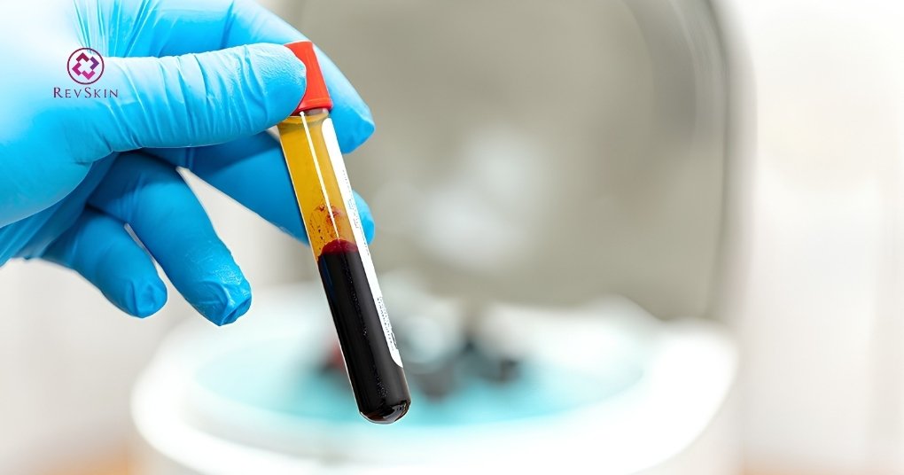 PRP bao lâu làm 1 lần? Các yếu tố ảnh hưởng thời gian giãn cách tiêu chí kết thúc liệu trình prp
