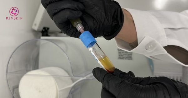 quy trình kỹ thuật tiêm prp 