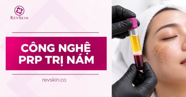 thumb công nghệ prp điều trị nám