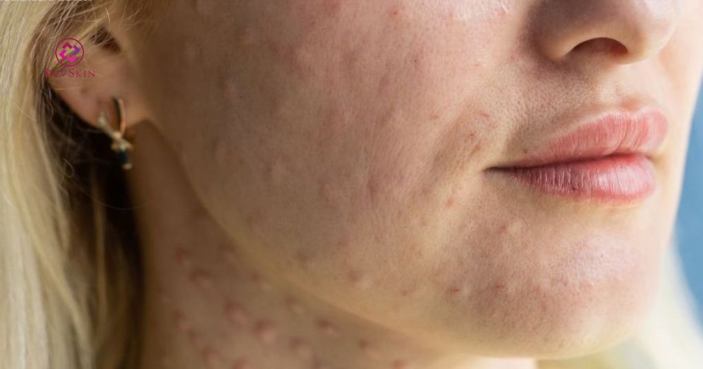 Quy trình thực hiện PRP theo tiêu chuẩn y khoa u hạt và phản ứng viêm sau tiêm prp